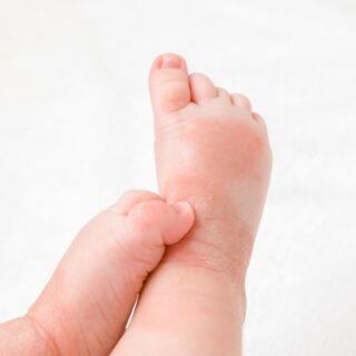 Kako negovati suvu kožu sklonu ekcemu kod beba?
