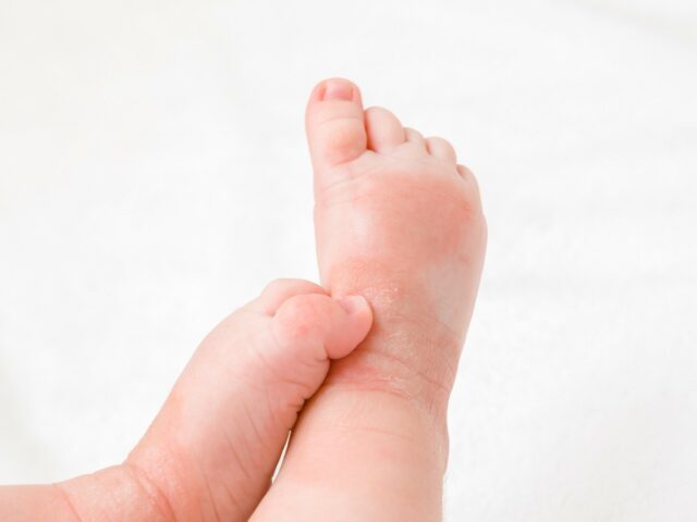 Kako negovati suvu kožu sklonu ekcemu kod beba?