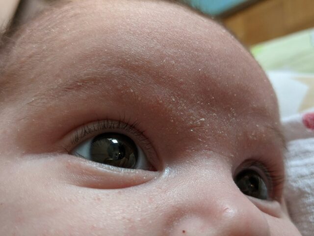 Problem temenjače kod beba?