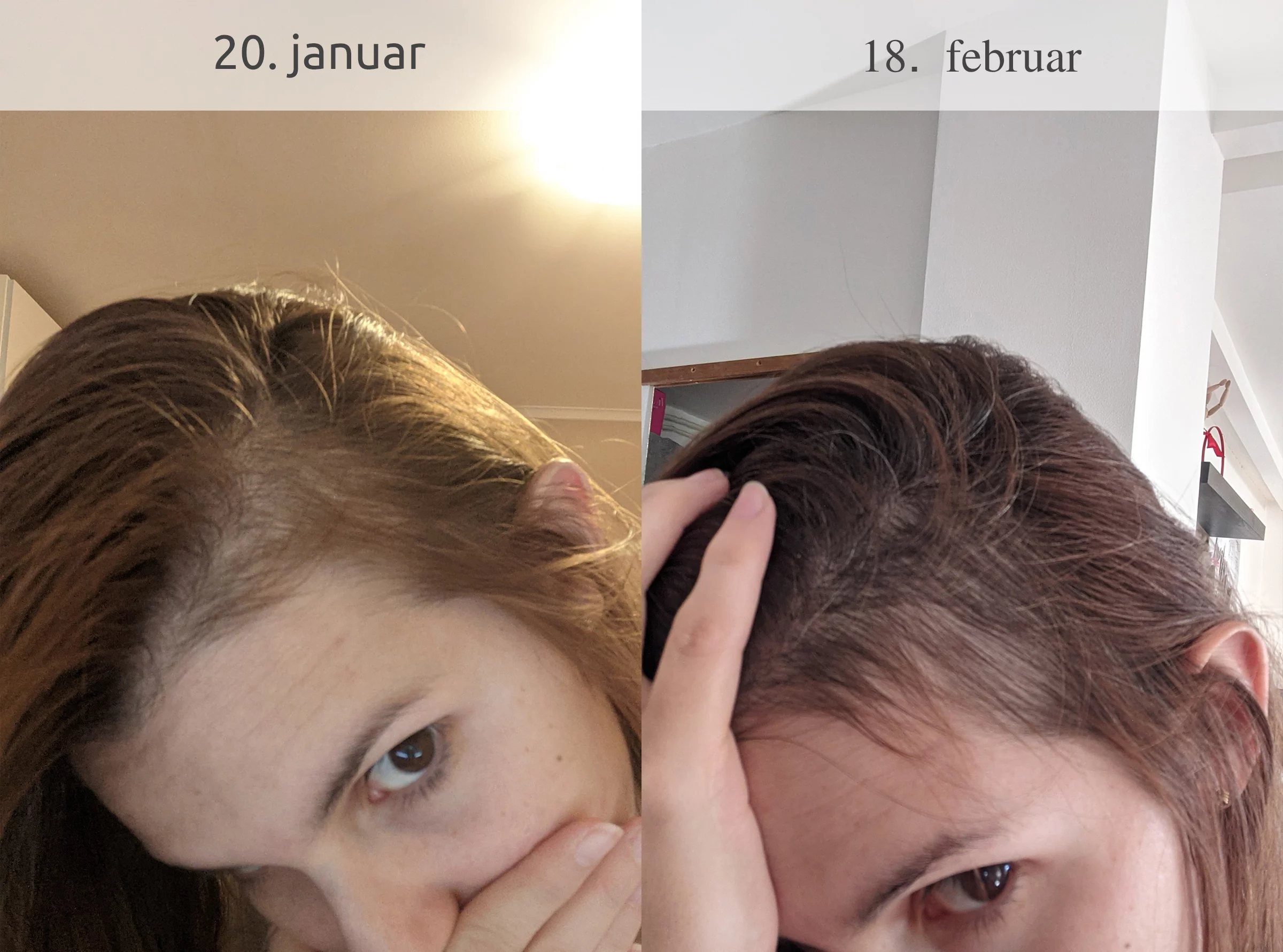 pre i posle - Opadanje kose